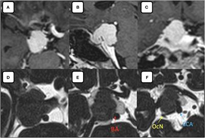 Case report: Endoscopic endonasal transposterior clinoid approach for resection of posterior clinoid process meningioma: technical notes and literature review